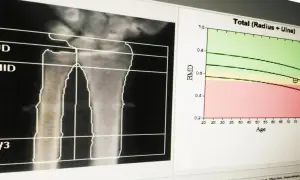 Wynik badania gęstości kości: analiza radiologiczna przedramienia z wykresem BMD w funkcji wieku.