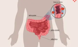 Ilustracja układu pokarmowego z zaznaczonym jelitem grubym, cienkim i odbytnicą. Powiększony fragment pokazuje krew na kale.