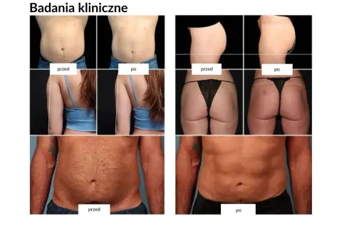Przed i po zabiegu: widoczne zmiany w sylwetce po treningu ems. Brzuch, ramiona i pośladki prezentują imponujące efekty.