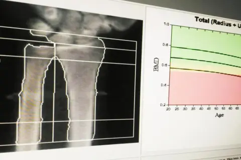 Wynik badania gęstości kości: analiza radiologiczna przedramienia z wykresem BMD w funkcji wieku.