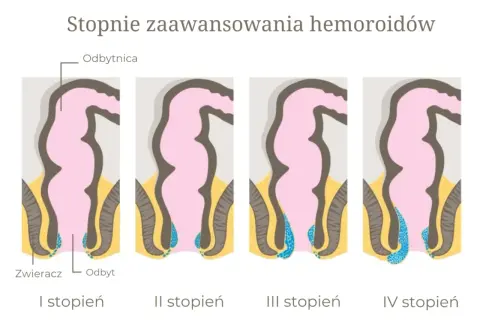 Stopnie zaawansowania hemoroidów: I-IV. Unikaj działań pogarszających hemoroidy, jak siedzenie w toalecie.