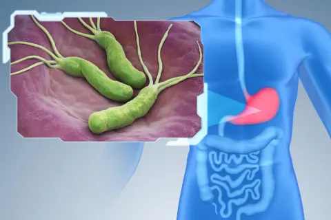 Bakterie Helicobacter pylori na błonie śluzowej żołądka. Czy helicobacter jest zaraźliwy? Tak, przenosi się drogą pokarmową.