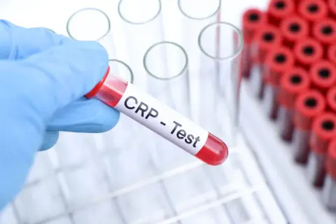 Rękawiczka w niebieskiej rękawiczce trzyma probówkę z napisem "CRP - Test". To badanie CRP pomaga wykryć stan zapalny w organizmie.