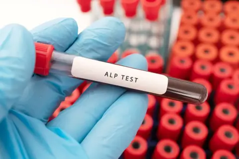 Rękawiczka w niebieskiej rękawiczce trzyma probówkę z napisem "ALP TEST". W tle widać stojak z czerwonymi probówkami. Dowiedz się, jak obniżyć fosfataza zasadowa.