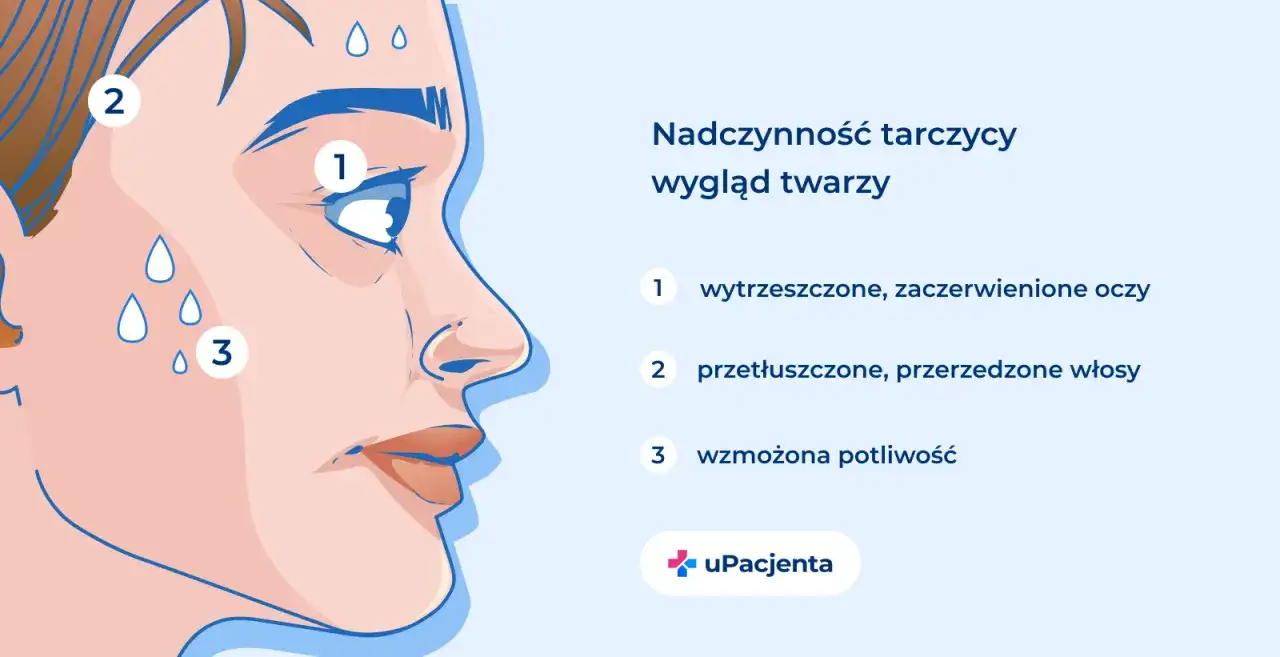 Objawy nadczynności tarczycy: wytrzeszczone oczy (1), przetłuszczone włosy (2) i wzmożona potliwość (3).