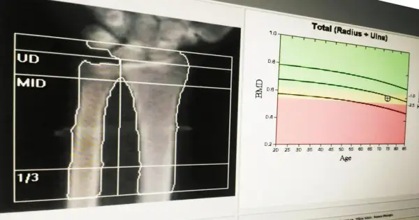 Wynik badania gęstości kości: analiza radiologiczna przedramienia z wykresem BMD w funkcji wieku.